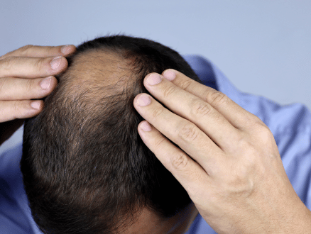 Male pattern baldness in men