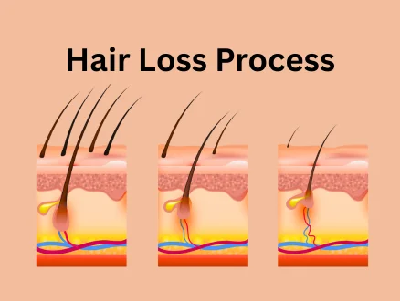 Best Hair Treatment Clinic in Gurugram