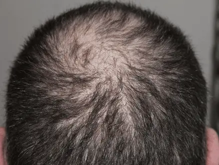 Hair Transplant Recovery