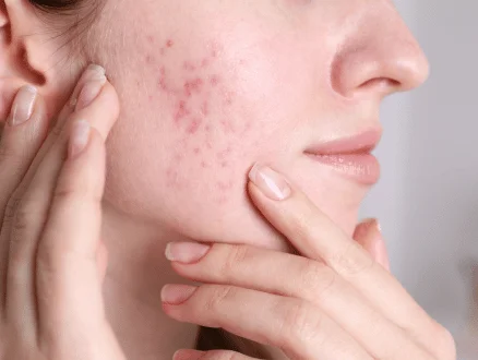 Acne scar removal in Gurgaon at Arka Skin Clinic